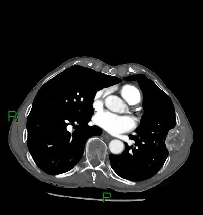 Rib hypervascular metastasis (clear cell renal cell carcinoma ...