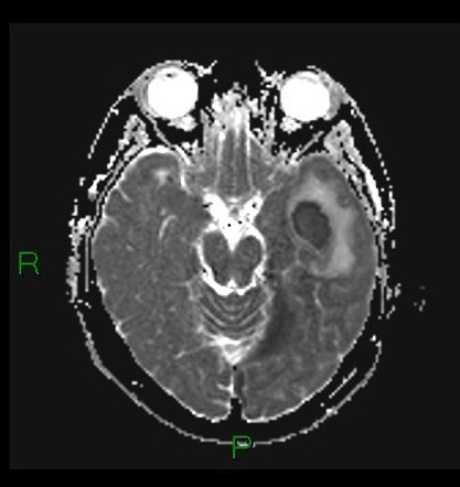 Cerebral abscess and subdural empyema | Image | Radiopaedia.org