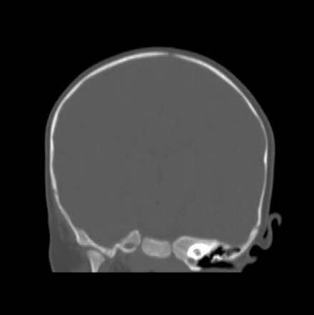 Plagiocephaly | Radiology Case | Radiopaedia.org