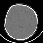 Plagiocephaly | Radiology Reference Article | Radiopaedia.org