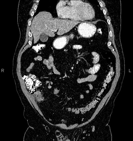 Radiopaedia Appendicitis