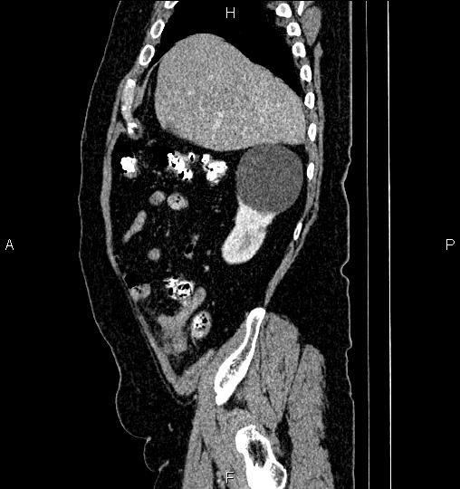 Tip appendicitis | Image | Radiopaedia.org