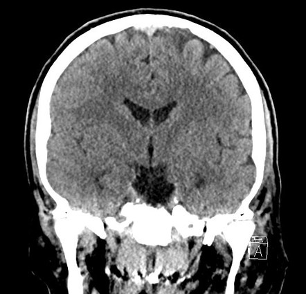 Unilateral Le Fort fracture - type 2 | Image | Radiopaedia.org