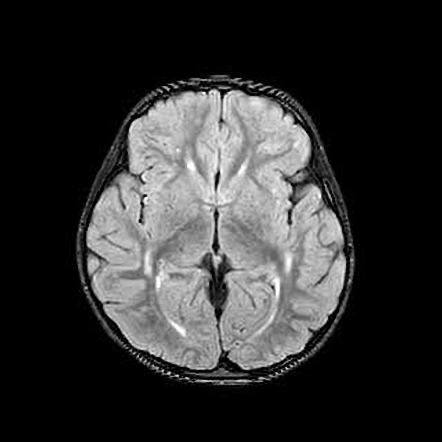 Acute Disseminated Encephalomyelitis (ADEM) | Radiology Case ...