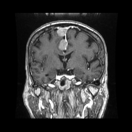 Multiple falcine meningiomas | Radiology Case | Radiopaedia.org