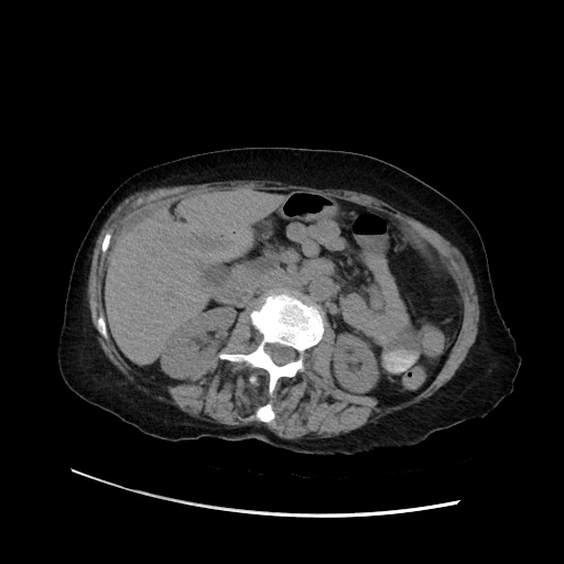 File:Closed loop small bowel obstruction due to adhesive band, with ...