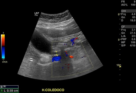 Gallbladder duplication | Image | Radiopaedia.org