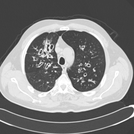 case study cystic fibrosis (cer)