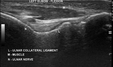 Anconeus muscle