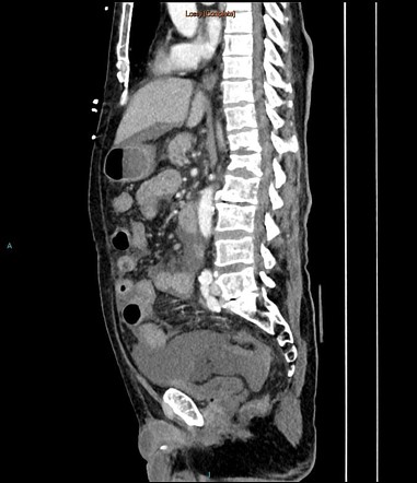 Spontaneous splenic rupture | Image | Radiopaedia.org