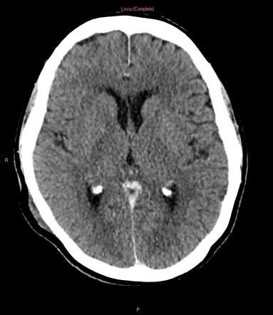 Diffuse large B cell lymphoma | Image | Radiopaedia.org