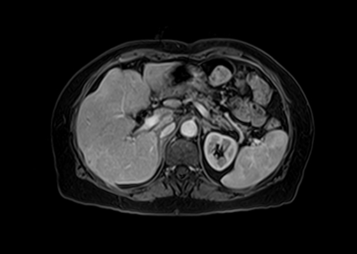 Confluent hepatic fibrosis | Image | Radiopaedia.org