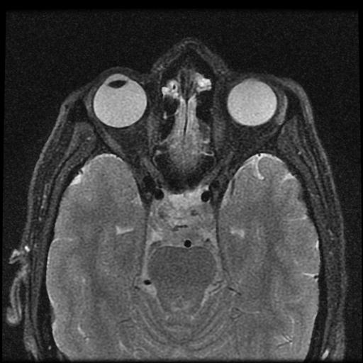 optic-nerve-atrophy-bilateral-image-radiopaedia