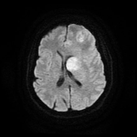 Multifocal glioblastoma - IDH wild-type | Image | Radiopaedia.org