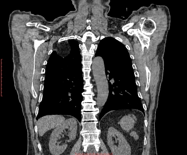 Pleural lipoma | Radiology Reference Article | Radiopaedia.org