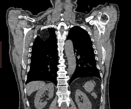 Pleural Lipoma