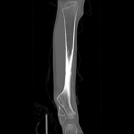 Hereditary multiple exostoses | Image | Radiopaedia.org