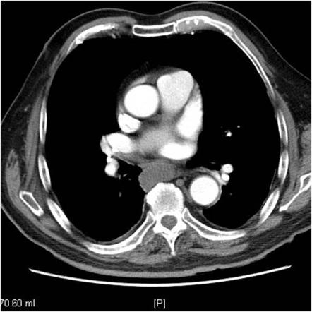 Bronchogenic cyst | Radiology Reference Article | Radiopaedia.org