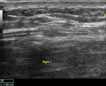 Muscle Hernia Bilateral Tibialis Anterior At Multiple Levels Radiology Case Radiopaedia Org