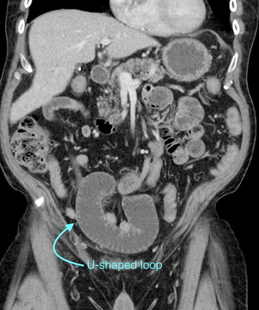 Closed loop obstruction Radiology Reference Article