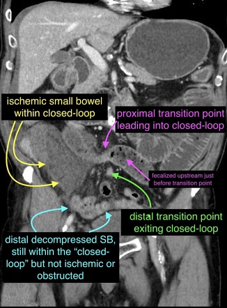 Closed loop obstruction due to adhesive band, resulting in small bowel ...