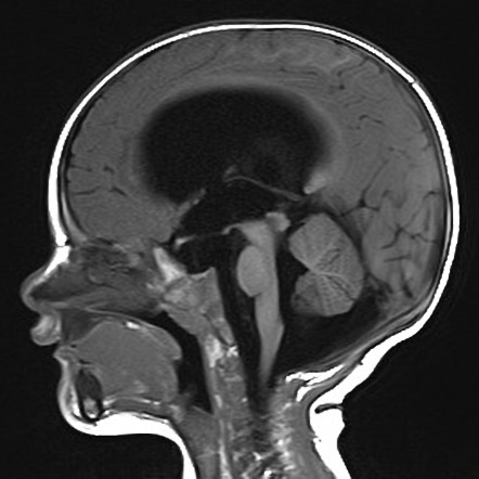 Choroid plexus papilloma | Image | Radiopaedia.org