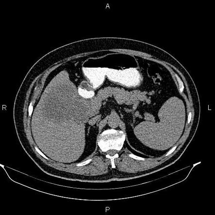 Gallbladder Adenocarcinoma | Image | Radiopaedia.org