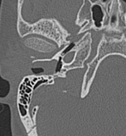 External auditory canal cholesteatoma | Radiology Case | Radiopaedia.org