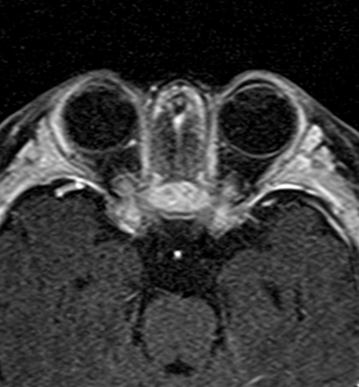 Bilateral Congenital Cataract Image