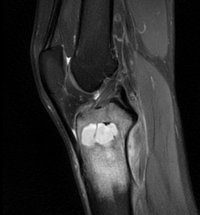 Brodie Abscess - Knee 