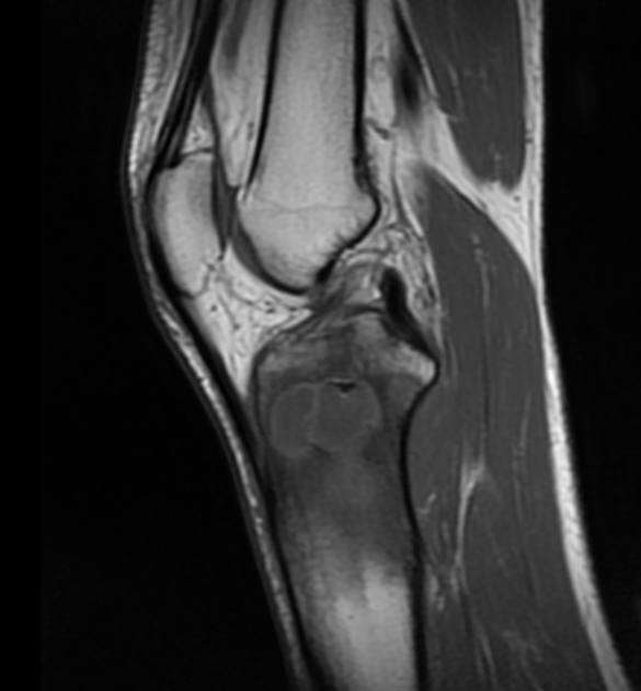 Brodie abscess knee Radiology Case Radiopaedia