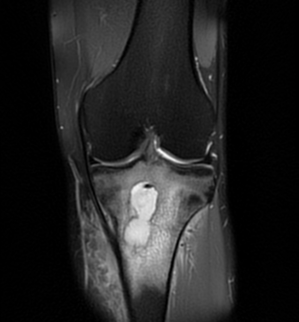 Brodie abscess Radiology Reference Article Radiopaedia