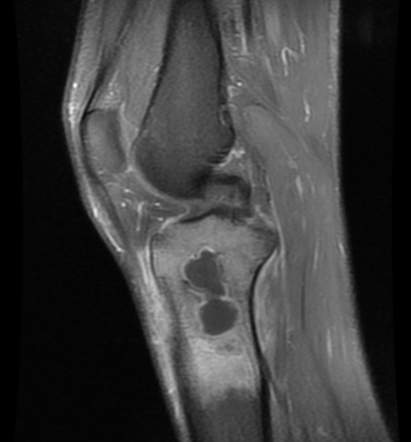 Penumbra sign (intraosseous abscess) | Radiology Reference Article ...