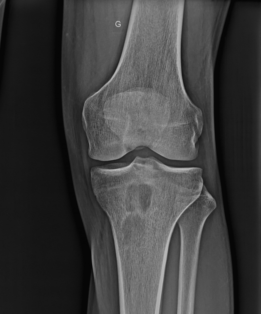 Brodie abscess knee Radiology Case Radiopaedia