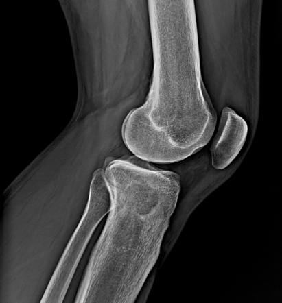 Brodie abscess - knee | Image | Radiopaedia.org