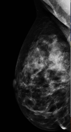 Ductal Carcinoma In Situ Recurrence | Radiology Case | Radiopaedia.org