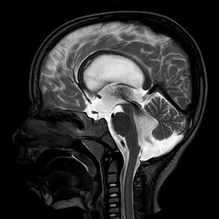 Blake's pouch cyst | Radiology Reference Article | Radiopaedia.org