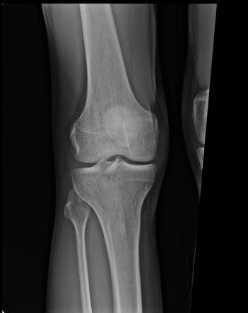 Posterior cruciate ligament bony avulsion | Radiology Case ...