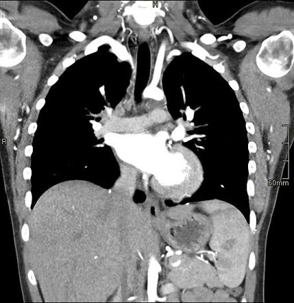 Aortic coarctation | Image | Radiopaedia.org