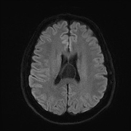 Cavum veli interpositi | Image | Radiopaedia.org