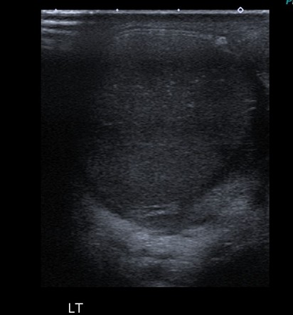 Torsed Testis Image Radiopaedia Org