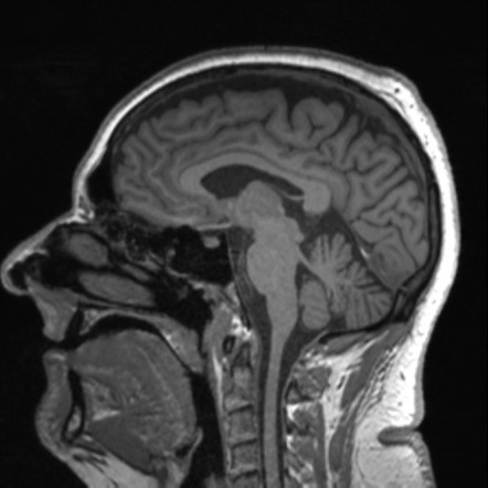 Glomus jugulotympanicum paraganglioma | Image | Radiopaedia.org