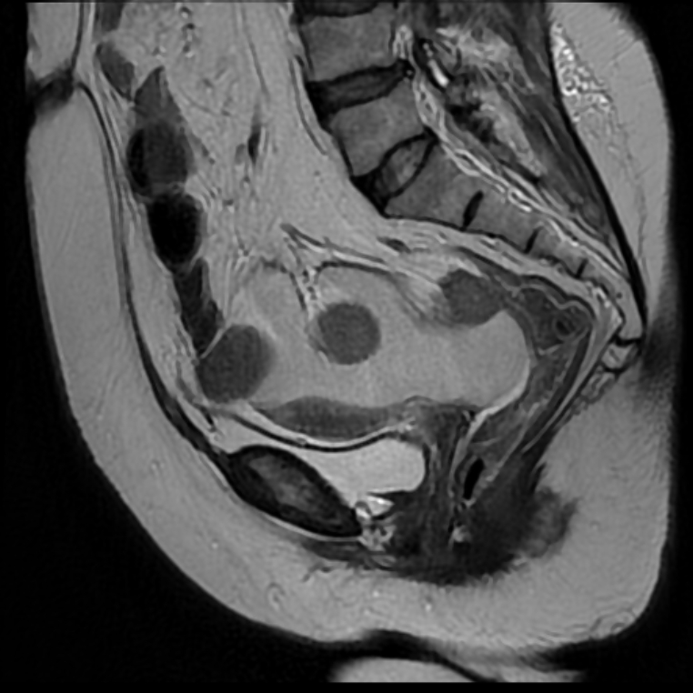 Perforated pelvic appendicitis | Image | Radiopaedia.org