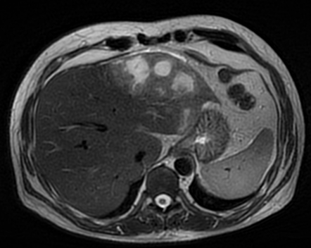 Perforated gastric ulcer with hepatic abscess | Radiology Case ...