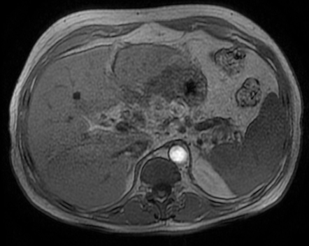 Perforated gastric ulcer with hepatic abscess | Image | Radiopaedia.org