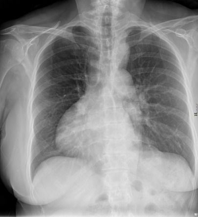 Dextrocardia and pseudocoarctation | Radiology Case | Radiopaedia.org