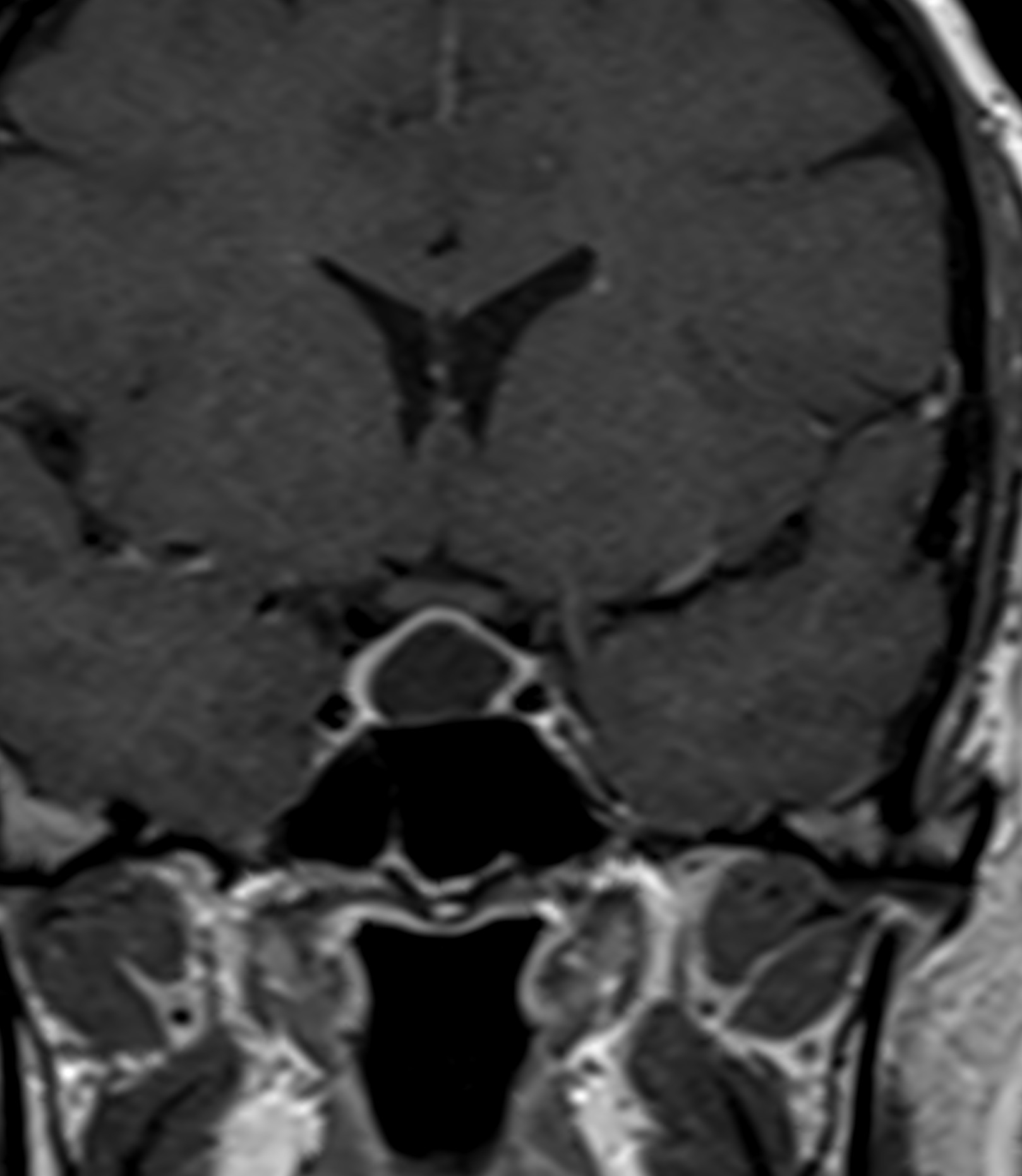 Rathke's cleft cyst | Image | Radiopaedia.org