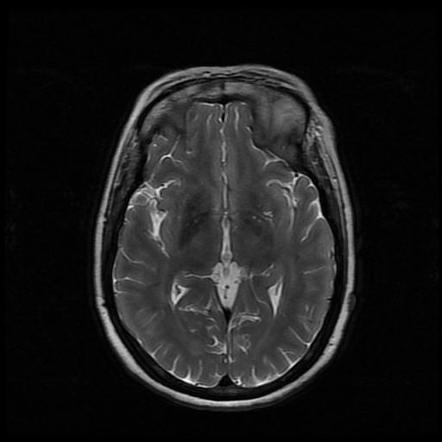 Basal Ganglia Hyperintensity