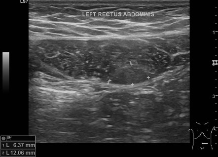 Rectus Abdominis Muscle Strain 