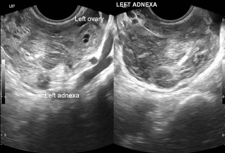 Tubal Ectopic Pregnancy 